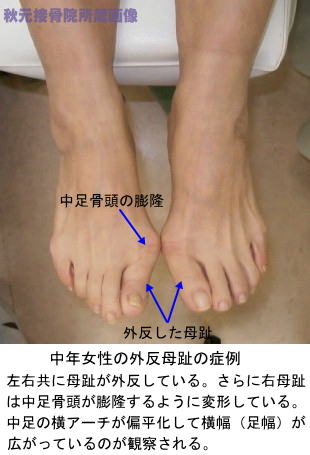 中年女性の外反母趾症例