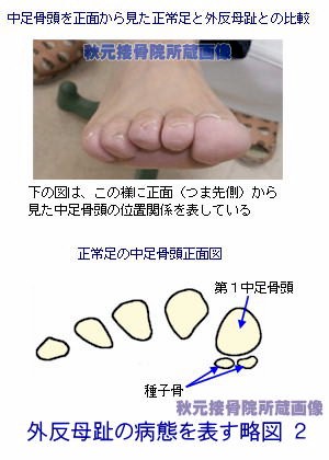 外反母趾の病態略図