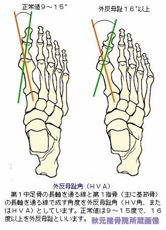 正常な足と外反母趾の比較