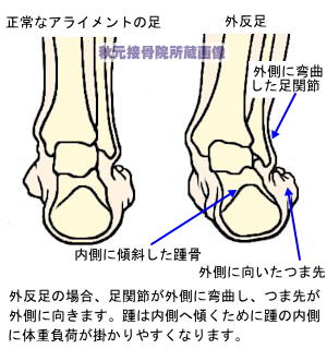 正常な足の姿勢と外反足の比較