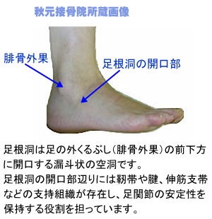 足の外くるぶしの痛み しびれ 足根洞症候群