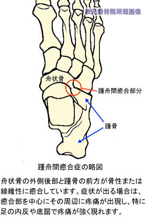 足根骨癒合症〜踵舟間癒合の略図