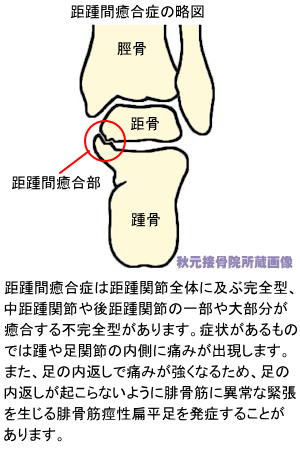 足根骨癒合症〜距踵間癒合の略図