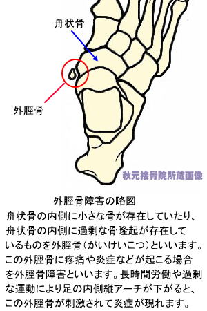 外脛骨障害の略図
