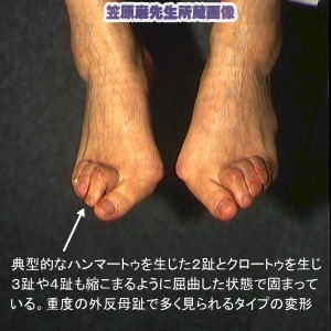 足指のしびれ 痛みの原因と病名