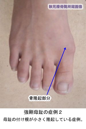 強剛母趾の症例２