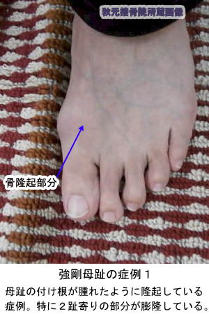 強剛母趾の症例１