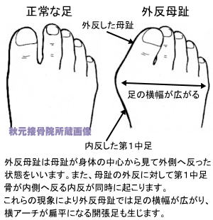 外反母趾と正常な足の比較