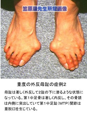 重度の外反母趾の一症例２