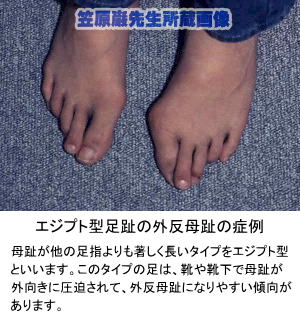 エジプト型足趾の外反母趾の症例