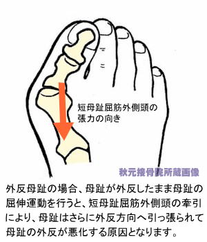 外反母趾における短母趾屈筋外側頭の作用