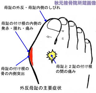 母趾の付け根の腫れ 痛み 外反母趾と病気の見分け方