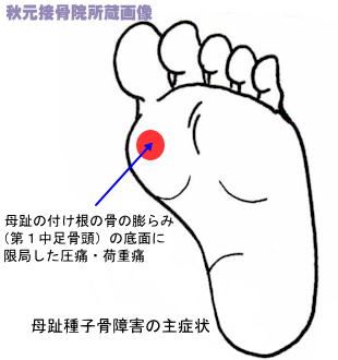 足の親指付け根の腫れ 痛み 外反母趾と病気の見分け方