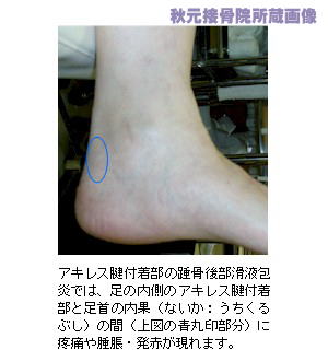 踵骨後部滑液包炎の症状出現位置