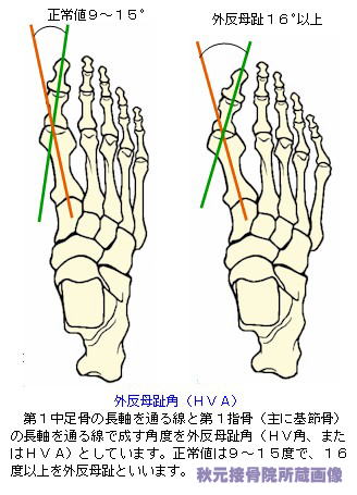 正常な足と外反母趾の骨格比較略図