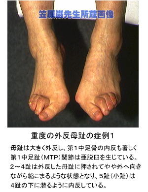 重度の外反母趾の一症例
