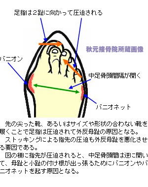 外反母趾の症状２
