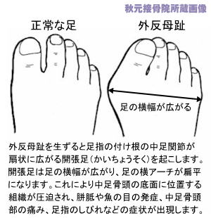 外反母趾と正常な足との比較
