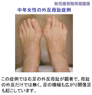 中年女性の外反母趾症例画像